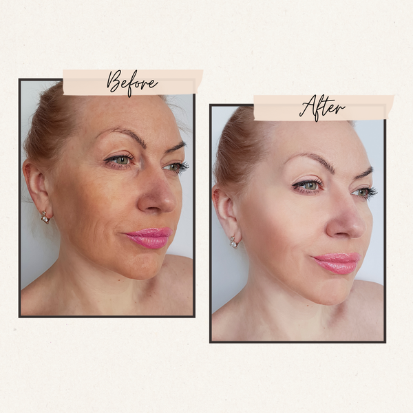 DermaLuxe Light Therapy Mask